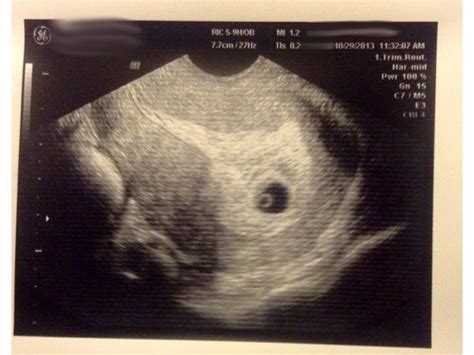 Now pregnant ard 6 weeks or more. . No gestational sac at 6 weeks success stories